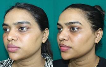 facial sculpting & chin implant